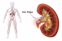 Địa chỉ vàng: Các bệnh viện điều trị sỏi thận tốt tại Hà Nội