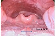 Trẻ 9 tuổi bị u lưỡi không ngờ lạc sản niêm mạc dạ dày hiếm gặp