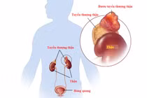 Chủ quan tăng huyết áp người bệnh bị u tuyến thượng thận đe dọa tính mạng