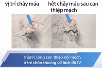 Can thiệp nội mạch cứu trẻ 5 tuổi vỡ lách độ IV