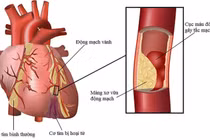 Các loại nhồi máu cơ tim