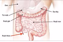  Ca đau ruột thừa không có triệu chứng 