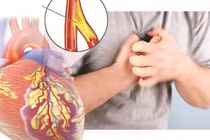 Tại sao gần đây bệnh mạch vành xuất hiện nhiều?