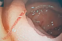 Suy kiệt vì giun mỏ lúc nhúc đâm thủng ruột non