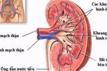 Bất thường mạch thận bẩm sinh