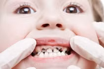 Đông y chữa bệnh cam răng
