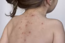 Bệnh thủy đậu là gì? Làm sao để cải thiện nhanh chóng tại nhà?