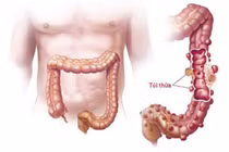 Đi ngoài ra máu cẩn trọng bị túi thừa Meckel