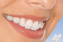 Lệch khớp cắn