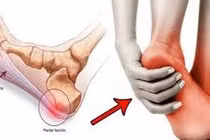 Bấm huyệt điều trị viêm đau gót chân