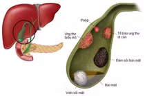 6 chữ S, dự đoán khả năng ác tính của polyp túi mật