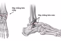 Bong gân mạn tính khớp cổ chân