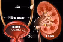 Sỏi tiết niệu gây tổn thương thận