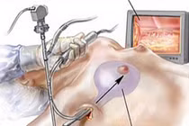 Đặt túi ngực sau lấy bỏ nhân xơ
