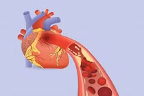 Dùng thuốc Nam có tránh tái phát nhồi máu cơ tim?
