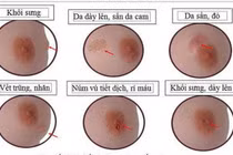 U vú tái phát, di căn vì mổ không đúng chuyên khoa