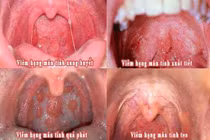 Viêm họng mạn tính có dẫn đến ung thư?