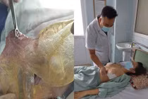Những rủi ro của phẫu thuật ngực