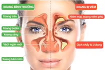 Cách nhận biết viêm xoang mặt