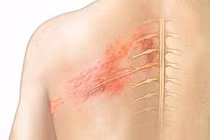 Zona thần kinh kéo dài bao lâu? Xem ngay thảo dược giúp cải thiện bệnh hiệu quả