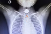 Đi chúc tết, bé trai 5 tuổi nuốt đồng xu phải cấp cứu 