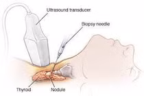 Sinh thiết tế bào trước mổ