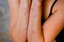 Chống rệp giường phá hoại giấc ngủ ngày lạnh