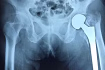 Gãy xương vùng khớp háng ở người cao tuổi: Chưa được quan tâm đúng mức?