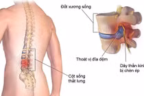 Biến chứng khi đốt nhiệt nội đĩa trị thoát vị đĩa đệm