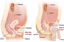 Viêm bàng quang do E.coli đa kháng