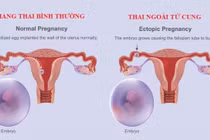 Suýt mất mạng vì chửa ngoài tử cung