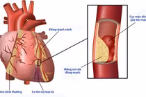  Bệnh mạch máu lớn dễ gây tử vong ở người đái tháo đường