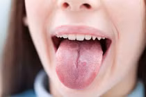 Dấu hiệu cảnh báo sớm bệnh ung thư lưỡi