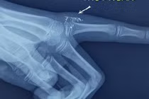 Bé gái 11 tuổi nhiễm độc thủy ngân do vỡ nhiệt kế