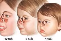 Viêm xoang ở trẻ em khác với người lớn
