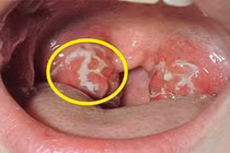  Vết loét và ung thư vòm họng