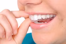 Thận trọng khi tự nắn chỉnh răng tại nhà