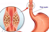 Bị ung thư thực quản nhiều nguy cơ mắc thêm ung thư thứ 2