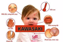 Trẻ sốt cao, phát ban cẩn thận bệnh Kawasaki nguy hiểm