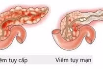 Cảnh giác nang giả tụy sau viêm tụy