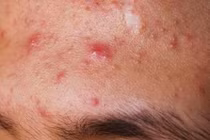 Hạn chế ăn ngọt để tránh mụn trứng cá