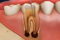 Biến chứng khủng khiếp chỉ từ viêm tủy răng 