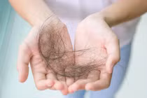 Thảo dược trị rụng tóc