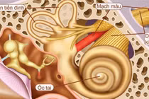 Chóng mặt cẩn thận u dây thần kinh thính giác