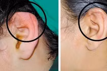 Khuyết tật nghe nói có phẫu thuật được không?