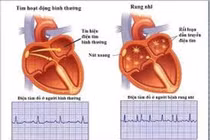 Rung nhĩ dễ đột quỵ 