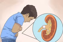 Hội chứng thận hư lại tưởng con bụ bẫm 