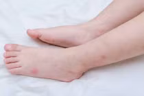 Cách xử lý khi bị kiến đốt