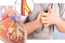 Đau ngực có phải do bệnh mạch vành?