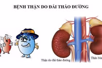 Tổn thương cầu thận ở bệnh đái tháo đường